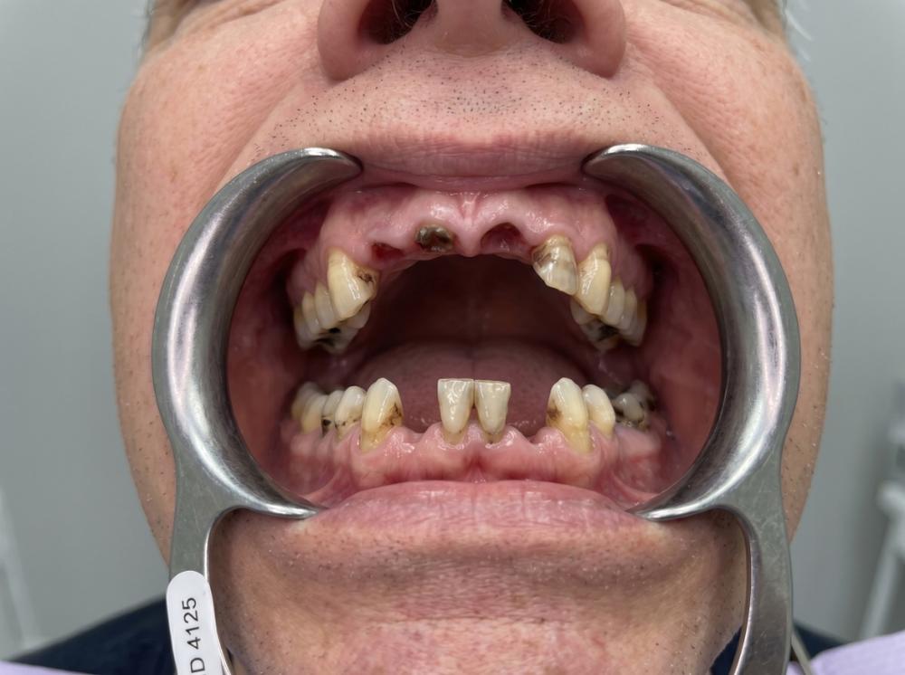Severe dental decay and bone loss before and after All-on-4 full arch dental implants restoration in Philadelphia - Before