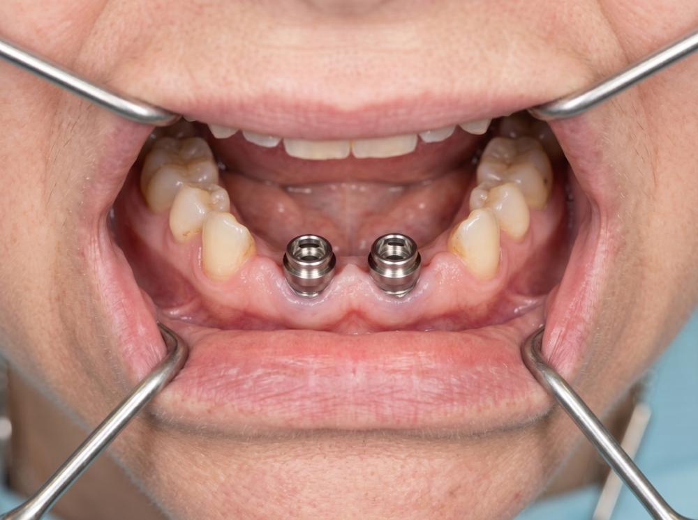 Lower jaw titanium abutments and custom pink snap-on overdenture mechanism before and after in Philadelphia - Before